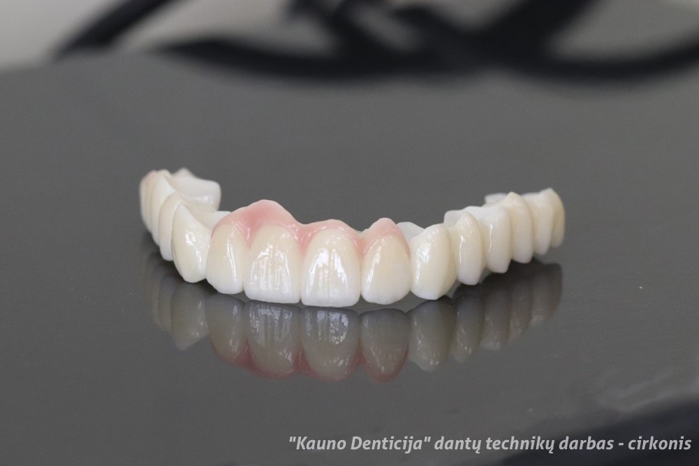 Galvojate apie dantų protezavimą metalo keramika? Yra geresnis sprendimas!