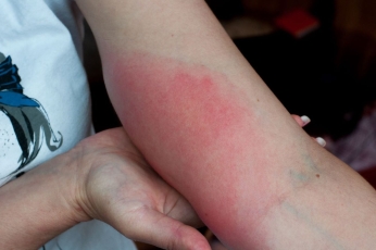 Laimo liga – klastinga: nediagnozavus laiku, pasekmių gali likti visam gyvenimui